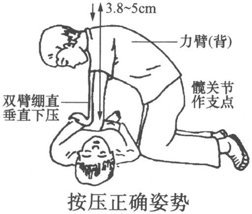 心肺復蘇模擬人操作常見錯誤心肺復蘇模型易犯錯誤