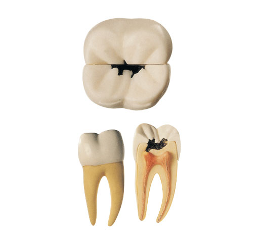 右側第一顆磨牙蛀牙模型